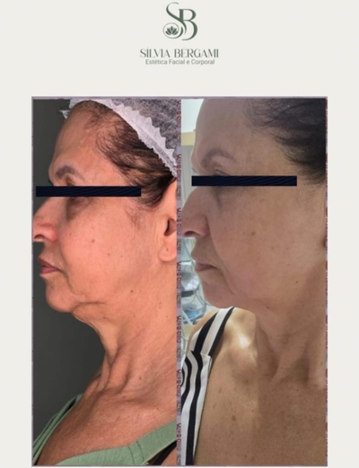 Peeling Químico