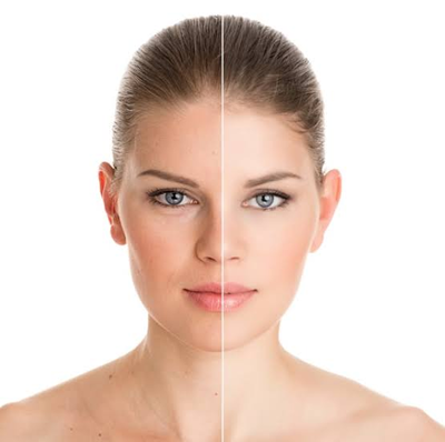 Rejuvenescimento facial