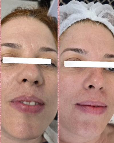 Tratamento Facial 3 Sessões